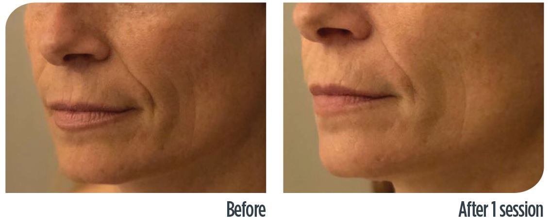 before-after-renova-1