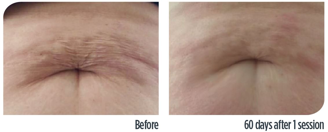 before-after-renova-2